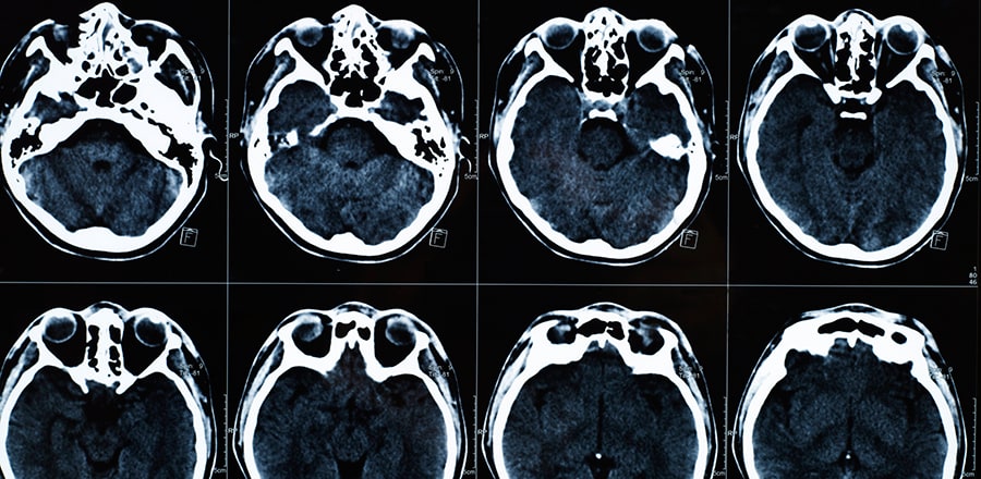 Chattanooga Traumatic Brain Injury Lawyers