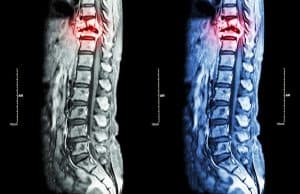 The Levels of Spinal Cord Injury, Explained