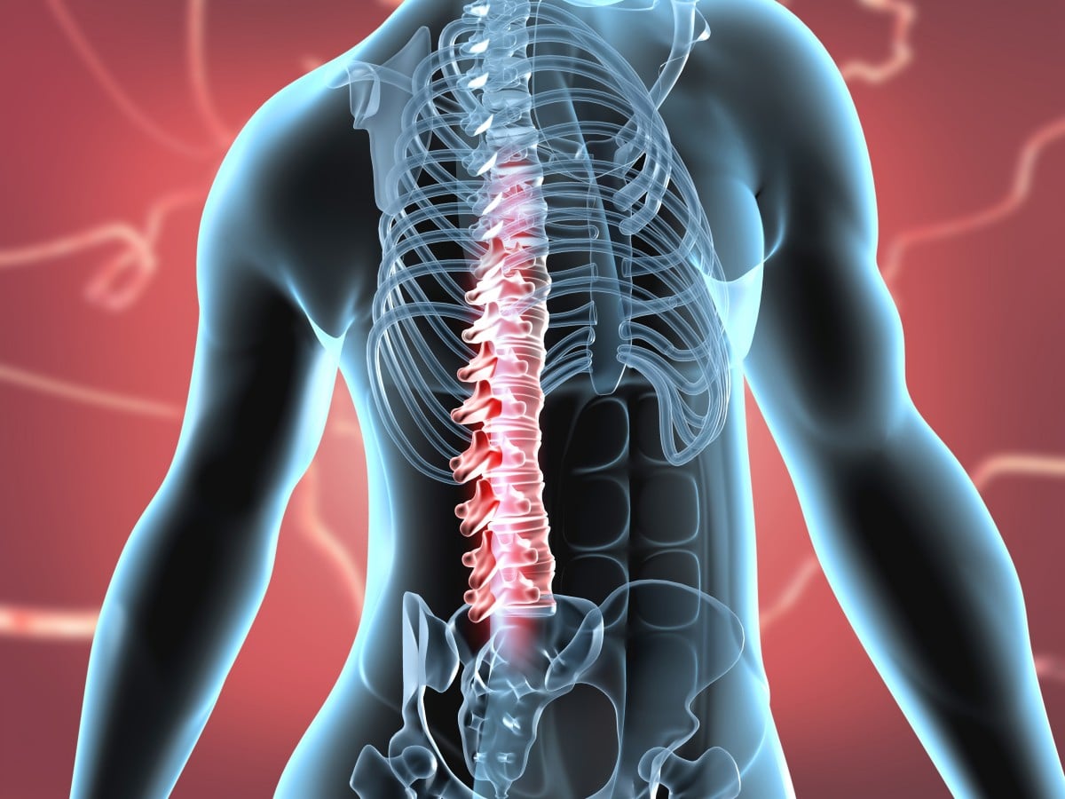 The Lifetime Financial Costs of a Spinal Cord Injury - Wagner & Wagner  Attorneys at Law