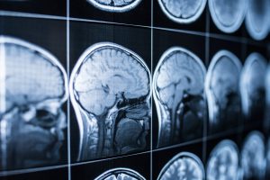 The Different Types of Traumatic Brain Injuries