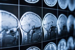 Which Serious Brain Injuries Are Caused by Vehicle Accidents?