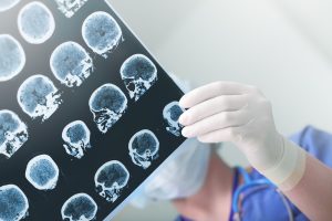 Understanding Traumatic Brain Injuries (TBI): Symptoms and Long-Term Effects